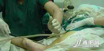 一个mm的抽脂减肥真实全程(图)