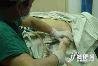 一个mm的抽脂减肥真实全程(图)