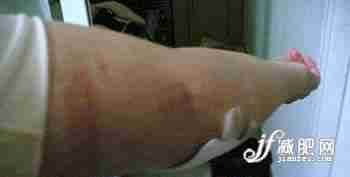 一个mm的抽脂减肥真实全程(图)