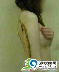 一个mm的抽脂减肥真实全程(图)