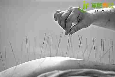 针灸减肥最宜单纯性肥胖