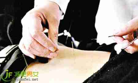 针灸减肥体重不减反升属正常