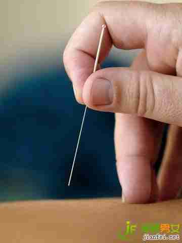 针灸减肥 5大误区需注意