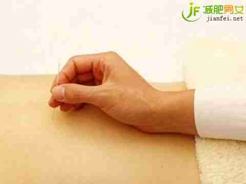 针灸减肥 5大误区需注意