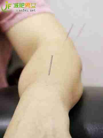 针灸减肥 5大误区需注意